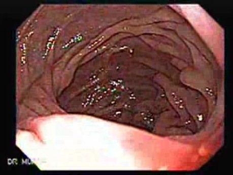 Chłoniak żołądka z przerzutami do dwunastnicy - ocena masy w opuszce dwunastnicy