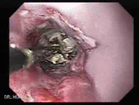 Przełyk Barretta i gruczolakorak połączenia żołądkowo-przełykowego - usunięcie tkanki martwiczej po rekanalizacji