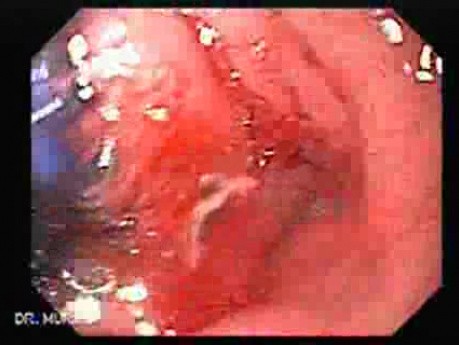 Pneumatyczna dylatacja przełyku - niewielkie krwawienie
