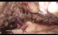 Nefrektomia laparoskopowa z dostępu pozaotrzewnowego