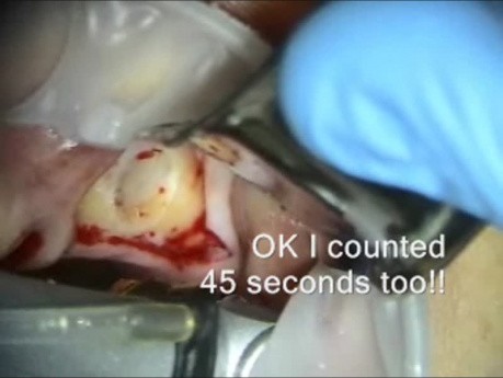 Mikrochirurgia implantologiczna z użyciem systemu Zimmer do bocznego dostępu do zatoki
