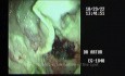 Cystogastrostomia - endoultrasonografia (EUS)