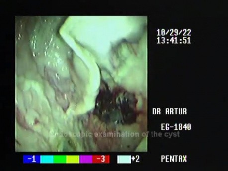 Cystogastrostomia - endoultrasonografia (EUS)