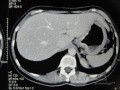 Obraz endoskopowy raka włóknistego żołądka obejmującego dno, trzon i część przedodźwiernikową (20 z 47)