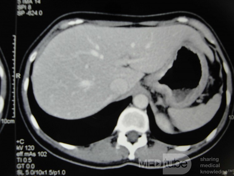 Obraz endoskopowy raka włóknistego żołądka obejmującego dno, trzon i część przedodźwiernikową (20 z 47)
