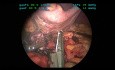 Laparoskopowa resekcja tętnicy śledzionowej z zaoszczędzeniem śledziony z powodu obecności 4 tętniaków