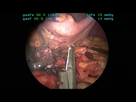 Laparoskopowa resekcja tętnicy śledzionowej z zaoszczędzeniem śledziony z powodu obecności 4 tętniaków