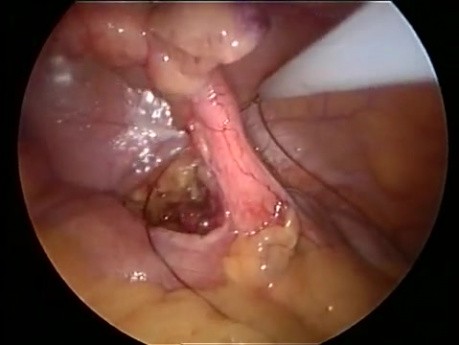 Appendektomia laparoskopowa metodą SILS