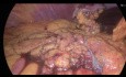 Laparoskopowa klinowa resekcja – GIST większej krzywizny żołądka