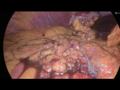 Laparoskopowa klinowa resekcja – GIST większej krzywizny żołądka