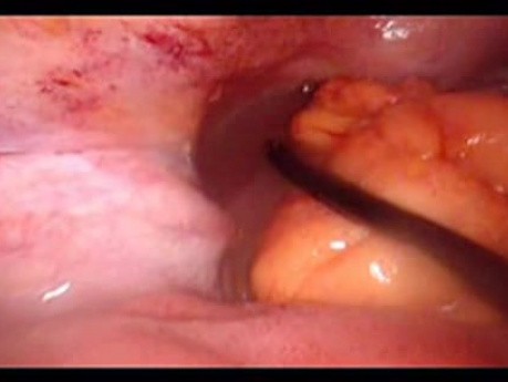 Perforacja okrężnicy z zapaleniem otrzewnej - laparoskopia (31 z 46)