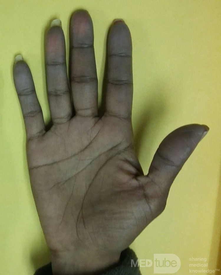 Objaw Raynauda