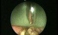 Ekspozycja krtani i biopsja polipa przedsionka pod kontrolą endoskopową