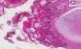 Rak płaskonabłonkowy - histopatologia - płuco