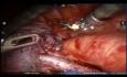 Segmentektomia lewostronna S6