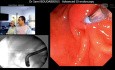 ERCP w zespole Mirizziego