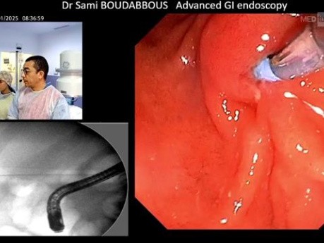 ERCP w zespole Mirizziego