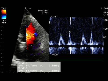 Pacjent z nadciśnieniem - EKG, ECHO, funkcja rozkurczowa LK