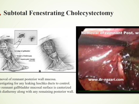 Trudna cholecystektomia