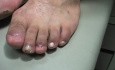 Stopień 4 wrośniętego paznokcia u palca nogi: 6 miesięcy później