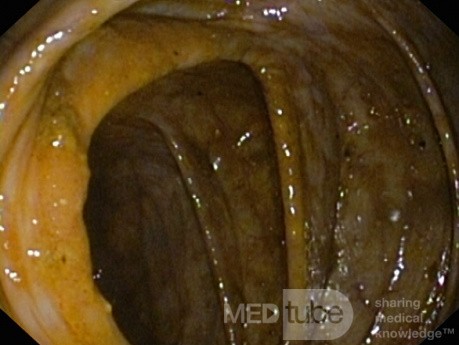 Rzekomobłoniaste zapalenie jelita grubego - obraz endoskopowy