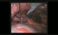 Zatrzymanie krwawienia podczas wideotorakoskopowej resekcji płata górnego płuca prawego przeprowadzonej z jednego portu.