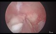 Usunięcie polipa endometrium - polipektomia endoskopowa