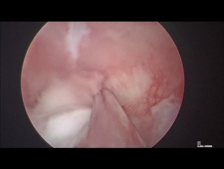Usunięcie polipa endometrium - polipektomia endoskopowa