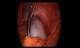 Wspomagana laparoskopowo operacja guza jajnika