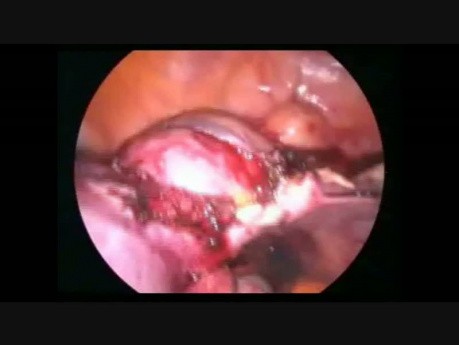 Histerektomia laparoskopowa z powodu dużego mięśniaka. 