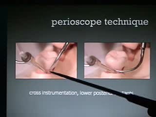 Technika pracy Perioscopem