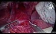 Laparoskopowa kardiomiotomia Hellera w przypadku nawracającej achalazji: czy operacja laparoskopowa jest wykonalna?