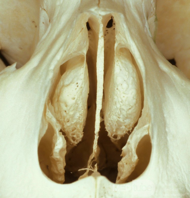 Obustronna małżowina puszkowa (okaz osteologiczny)