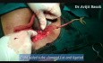 Chirurgia ciąży ektopowej 