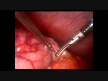 Minilaparoskopia guza żołądka