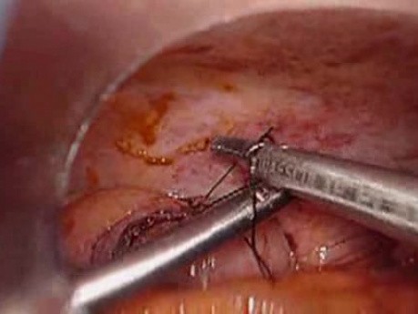 Perforacja okrężnicy z zapaleniem otrzewnej - laparoskopia (12 z 46)
