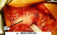 Przepuklina pachwinowa - operacja otwarta z użyciem siatki