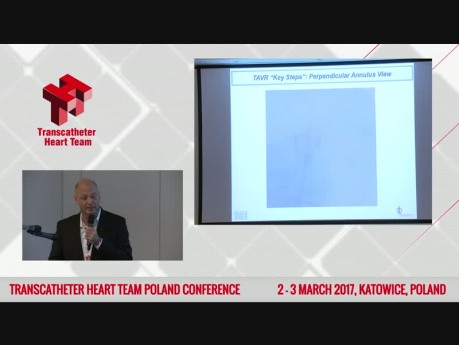 Minimalistic Approach to TAVI Using Edwards Sapien 3 System. Operator's Experience