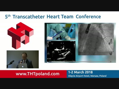 Transcatheter Direct Mitral Valve Annuloplasty with the Cardioband system
