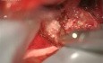 Zastosowanie matrycy TachoSil podczas operacji guza kąta mostowo-móżdżkowego