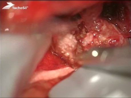 Zastosowanie matrycy TachoSil podczas operacji guza kąta mostowo-móżdżkowego