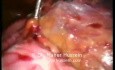 Laparoskopowa operacja węzłów chłonnych żyły głównej i aorty