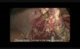 Pilna laparoskopia z powodu perforacji wyrostka robaczkowego