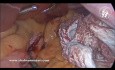 Laparoskopowa rękawowa resekcja żołądka
