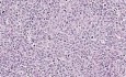 Chłoniak rozlany z dużych komórek B - histopatologia - węzeł chłonny