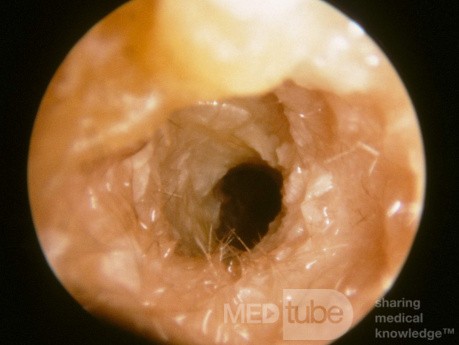 Ostre zapalenie ucha środkowego (stadium wchłaniania)
