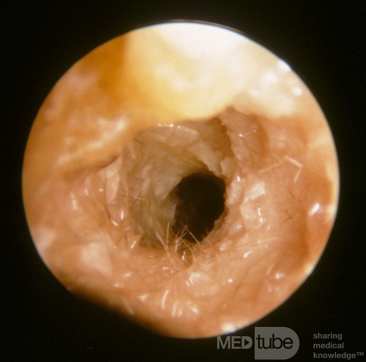 Ostre zapalenie ucha środkowego (stadium wchłaniania)