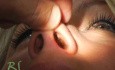 Operacja plastyczna nosa - film