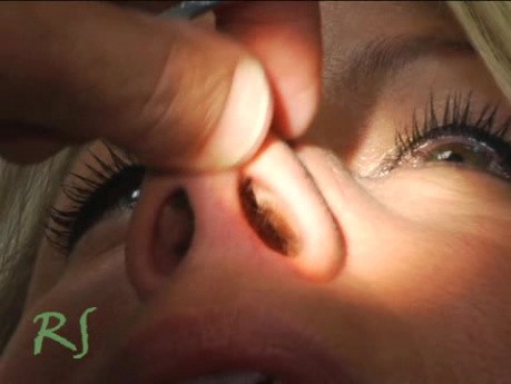 Operacja plastyczna nosa - film