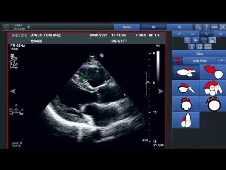 Wprowadzenie do prezentacji o technologii Ventripoint VMS+ w zakresie metryk kardiologicznych